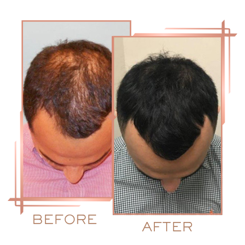Before and after for alopecia areata