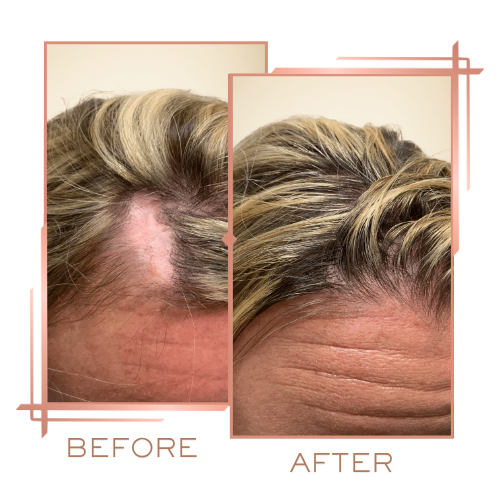 Before and after for male hair density