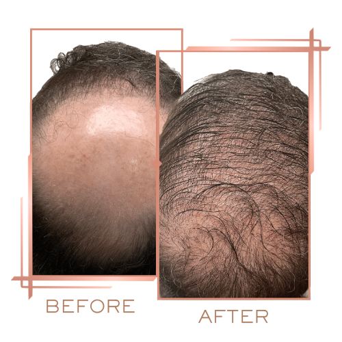 Before and after for male hair density