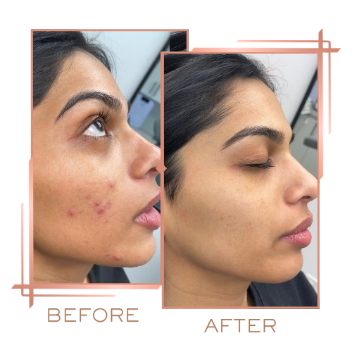 Patient before and after microneedling for acne scars