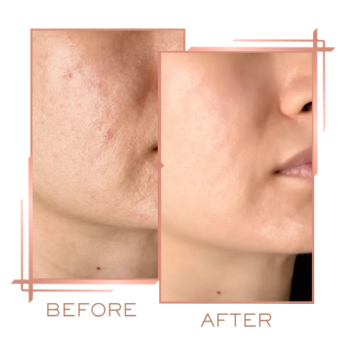 Patient before and after microneedling for wrinkles and skin texture