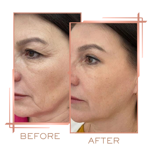 Before and after microneedling for pigmentation