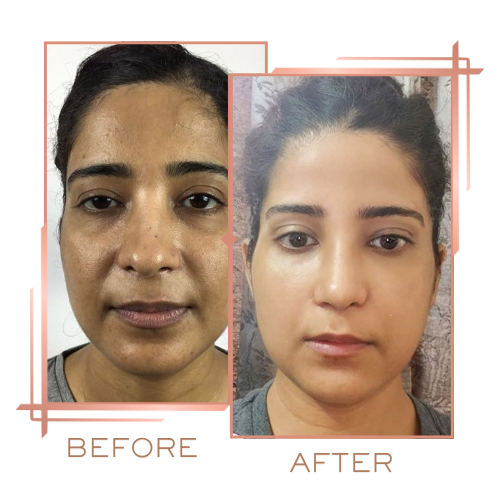 Before and after microneedling for overall skin tone and clarity