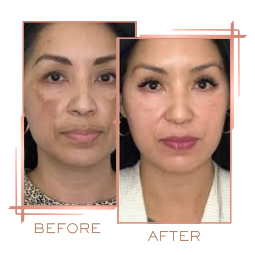 Before and after pigmentation treatment showing clearer skin