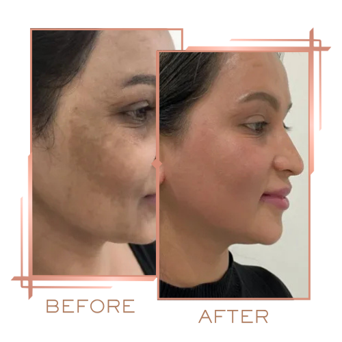 Patient before and after chemical peels for uneven skin tone