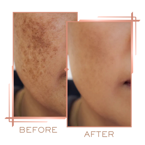Before and after melasma treatment showing significant reduction in dark patches